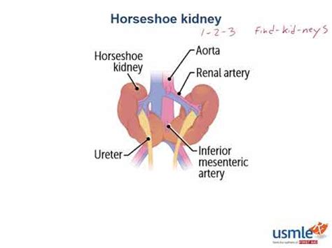horseshoe kidney treatment